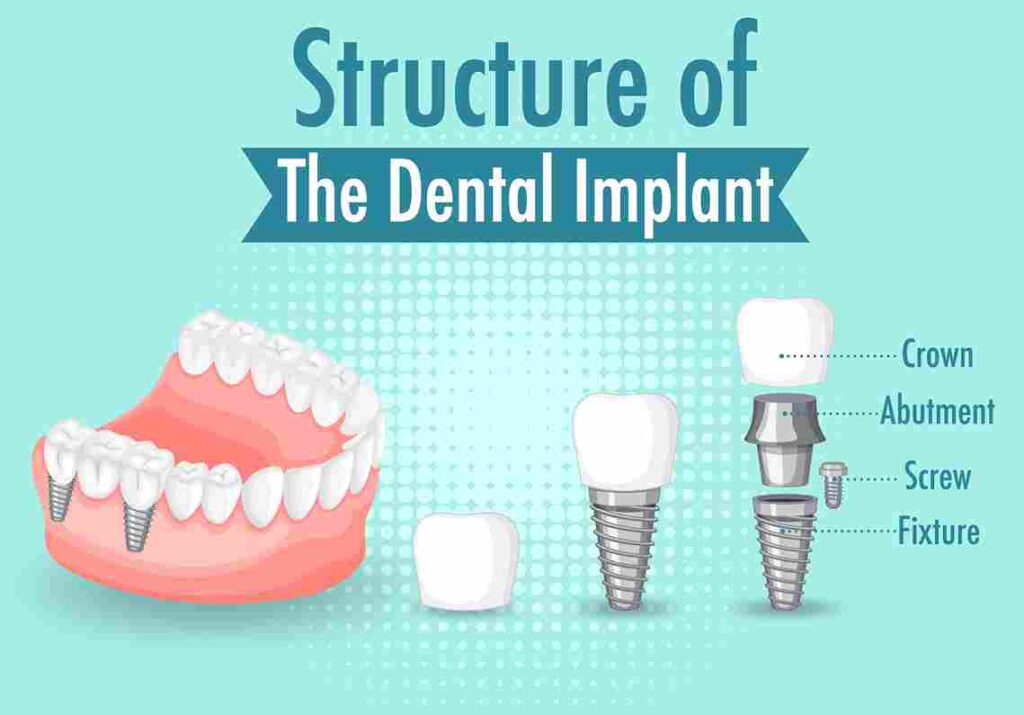 How long after dental implants can I eat normally